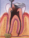 Root Canal1